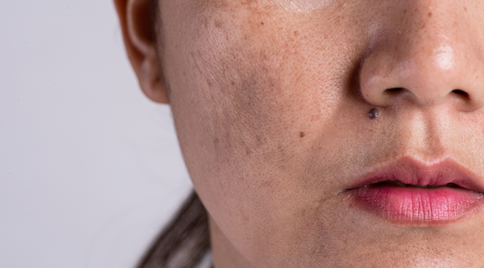 Best Moisturizer for Combination Skin