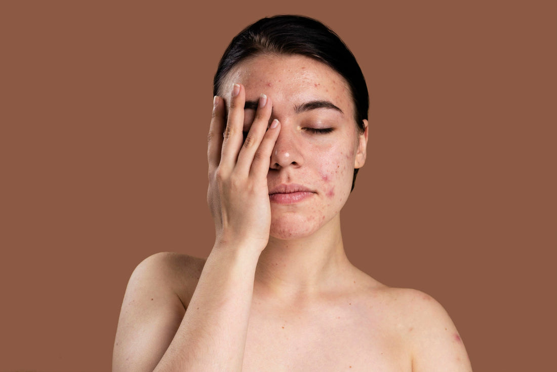 Woman covering one eye with visible facial pigmentation and blemishes on her cheeks
