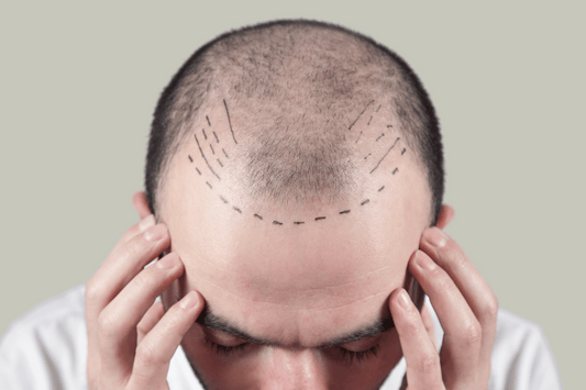 Hair Transplant